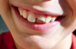 Leia mais sobre o artigo Quebrar os dentes da frente: o que fazer nessa situação?