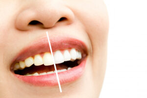 Como funciona o clareamento dental? 14 clareamento dental 2